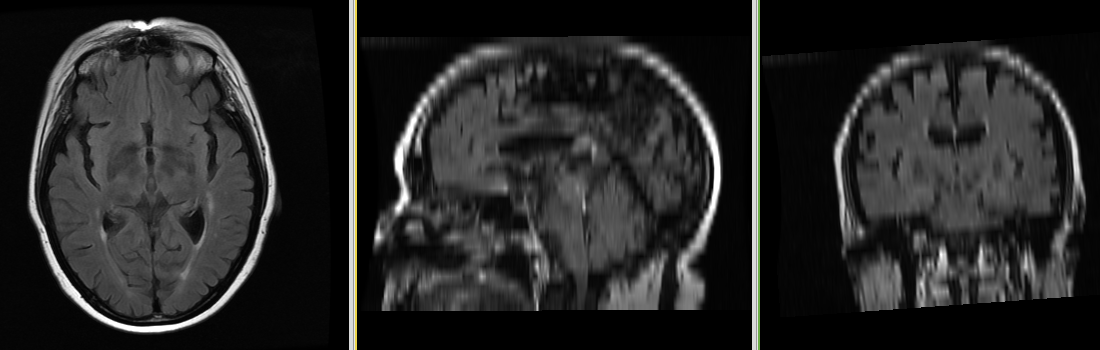 MRI-Human-Brain-HIPR-T2Flair.png