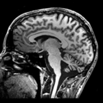 this is the MRI image in the original position.