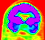 this is the PET scan, to be aligned with the MRI