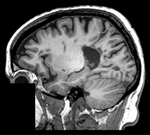 this is the fixed MRI reference image. All images are aligned into this space