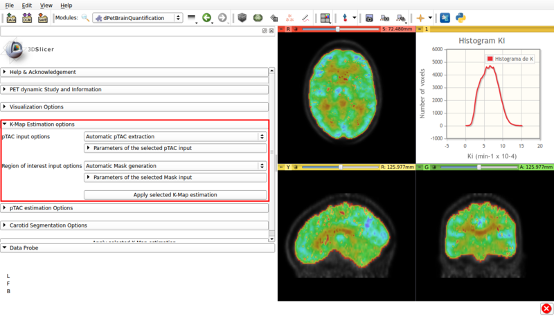 Figure 8. Screencap of the K-Map estimation panel. The estimated K-Map volume is overlaid over the dPET scan.