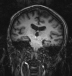 this is the fixed MRI reference image.